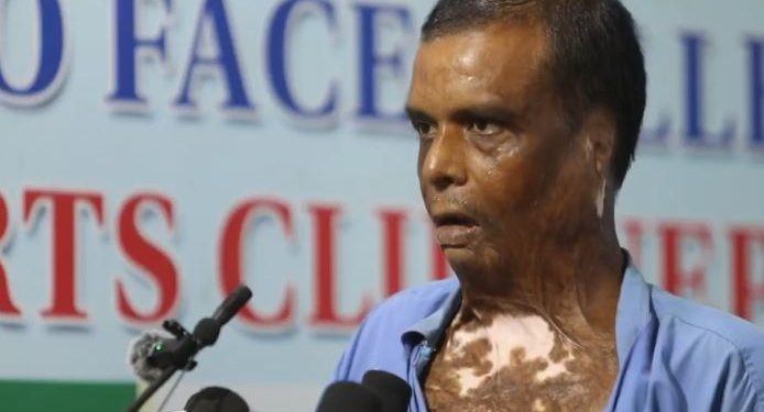 रौतहट बम विष्फोट घटनाः अफ्ताब छुटे, तर घाइते गौरीशंकरका घाउ अझै बल्झिरहेका छन्